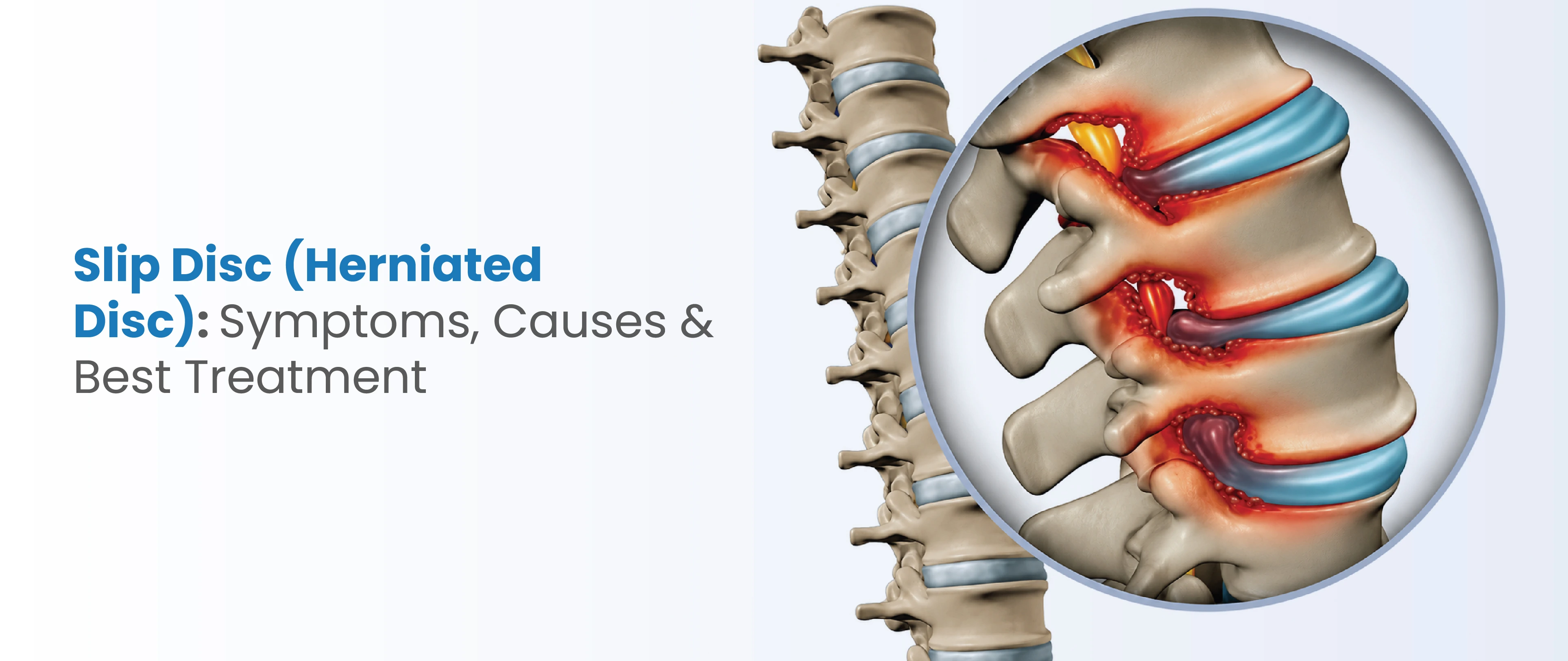 Slip Disc (Herniated Disc): Symptoms, Causes & Treatment Options